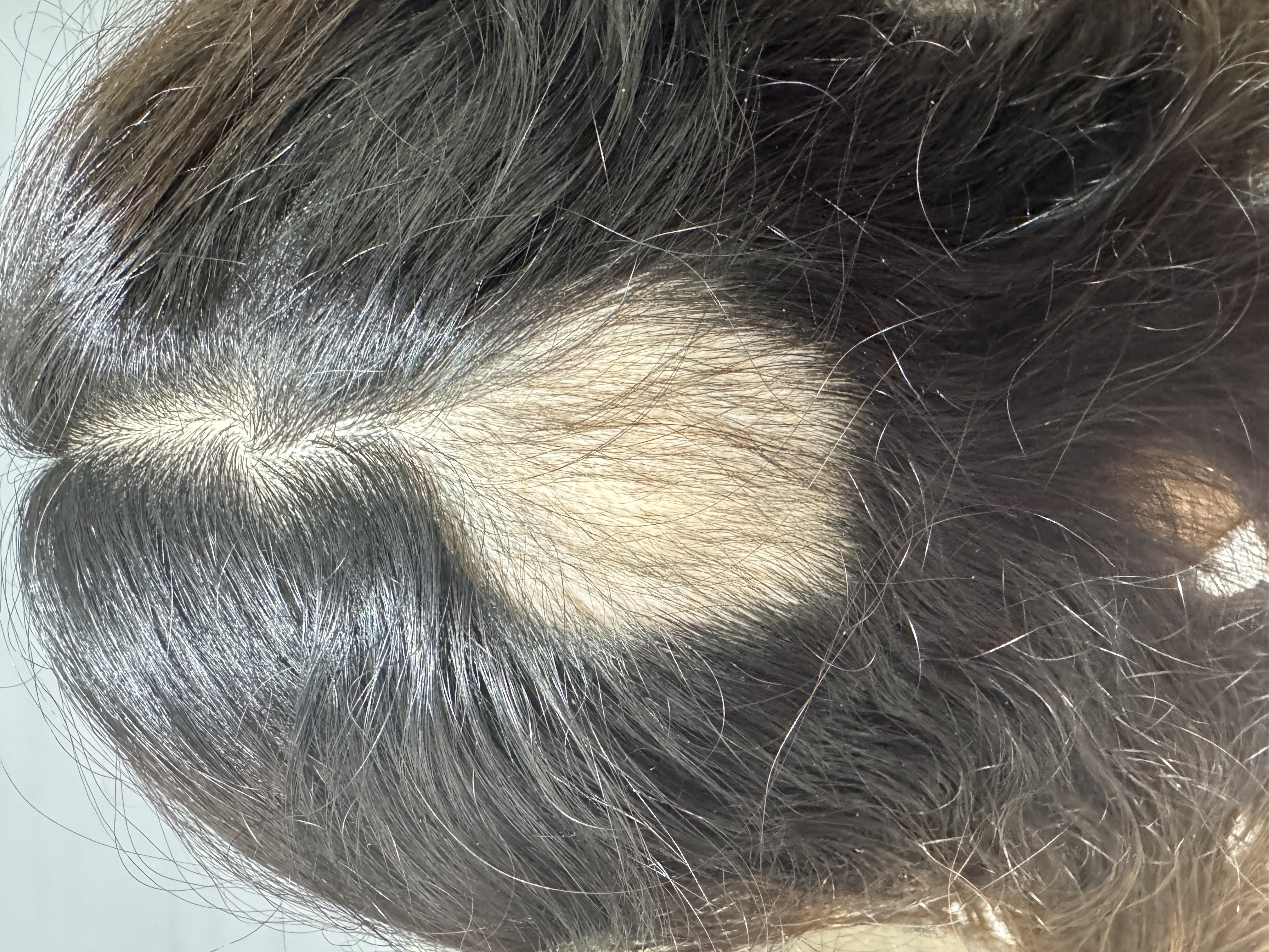 Alopecia Areata