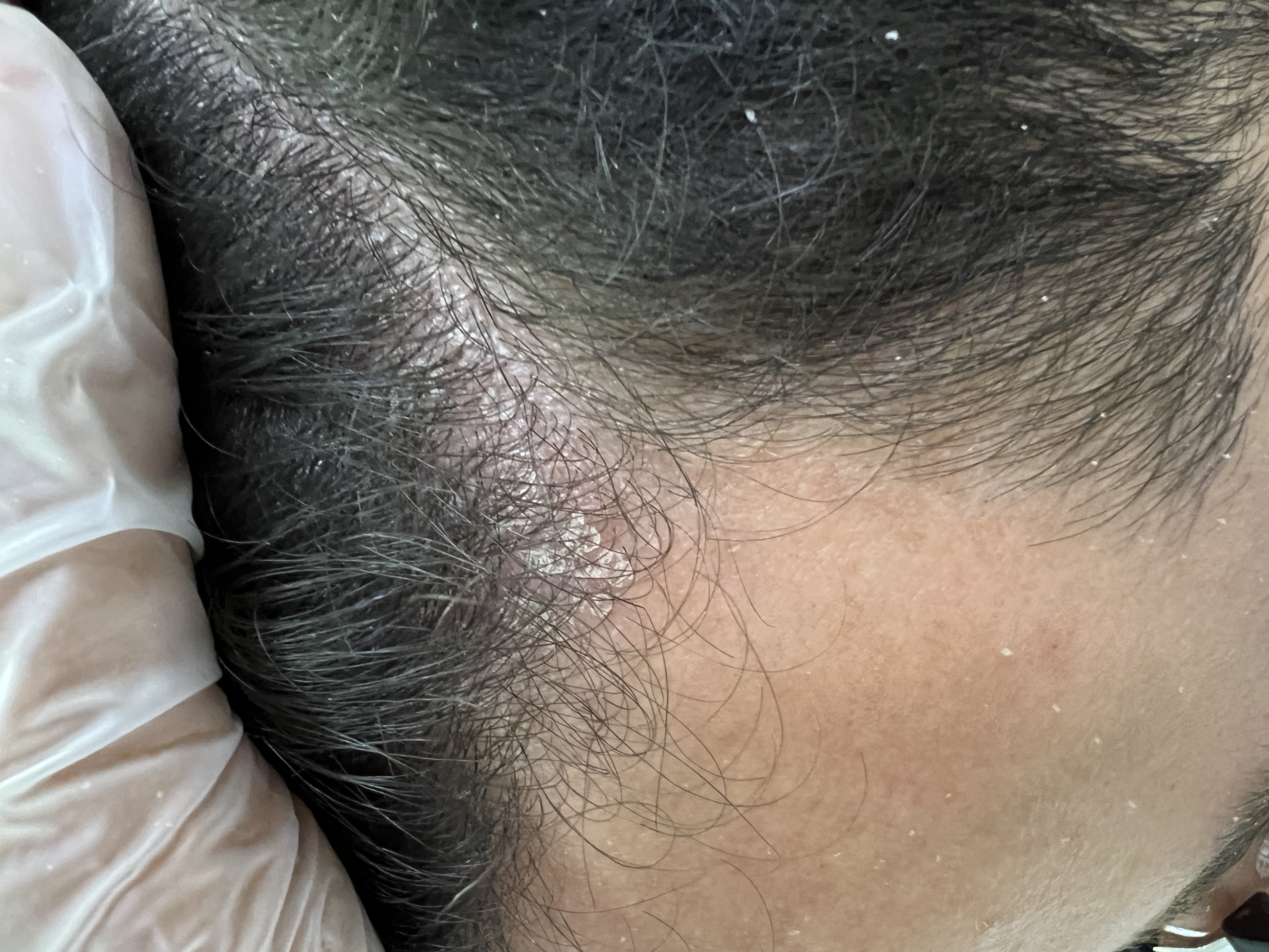 Dermatitis Seborreica