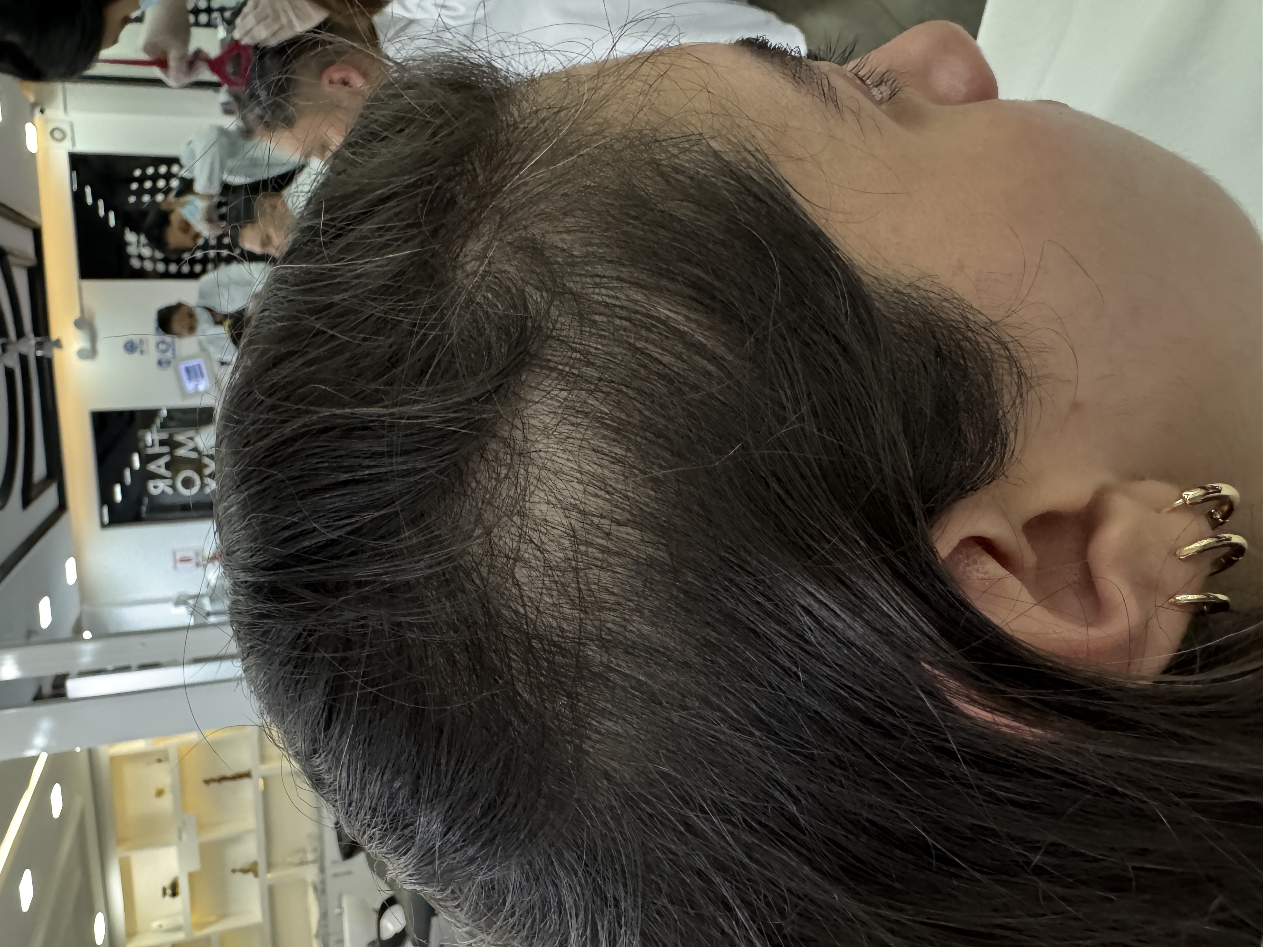 Alopecia Androgenética mujer después