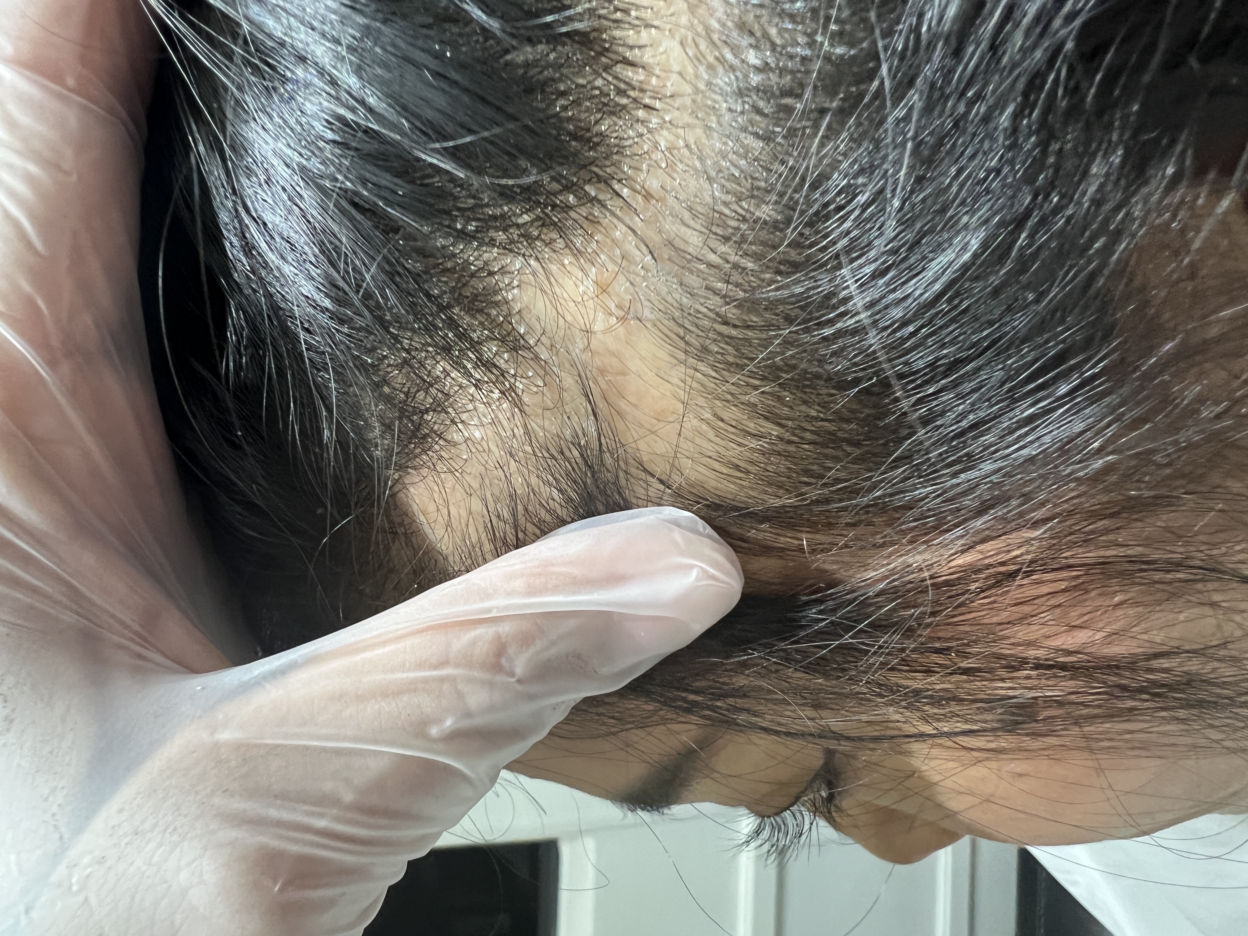 Alopecia Areata antes