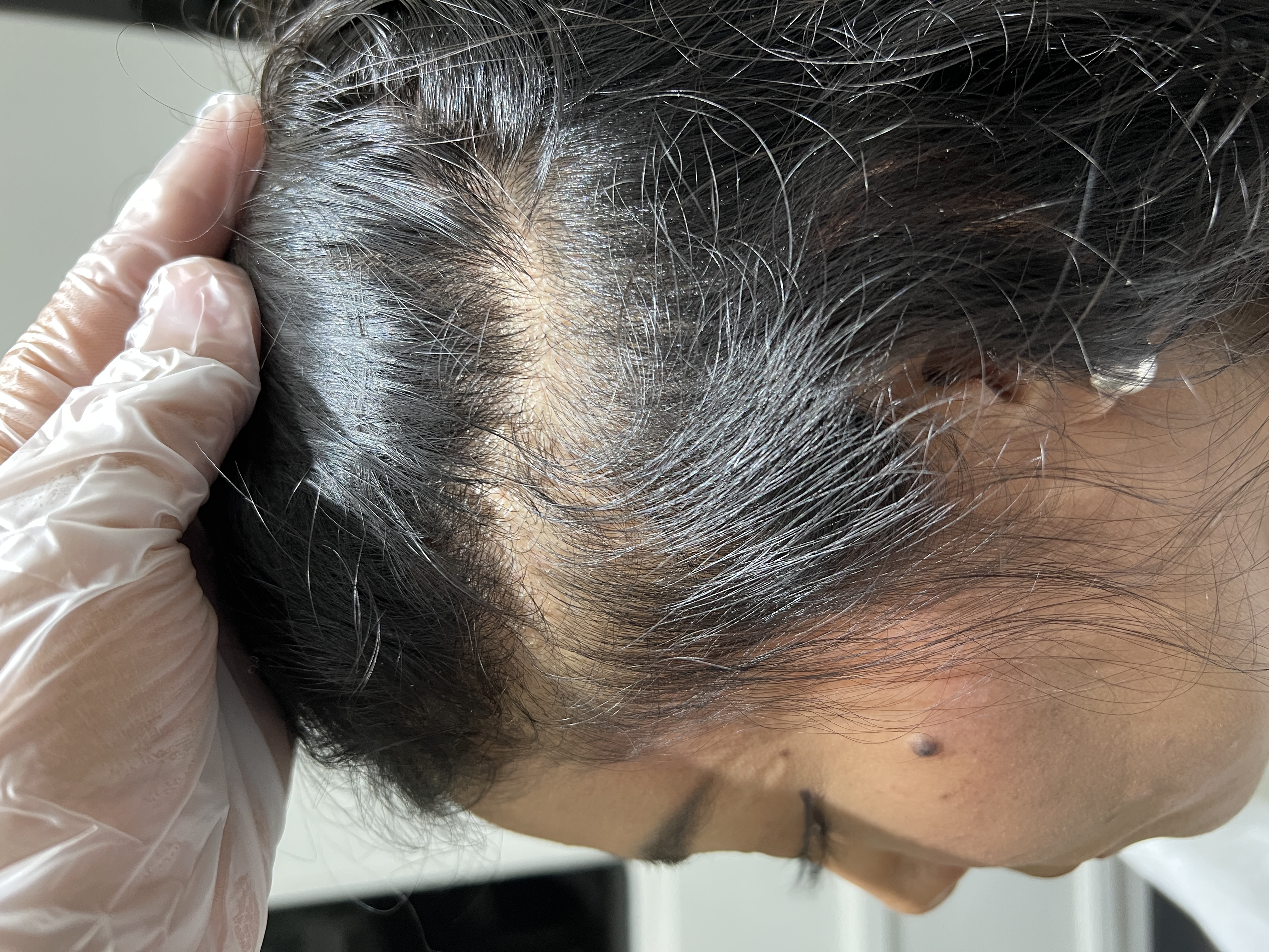 Alopecia Areata después