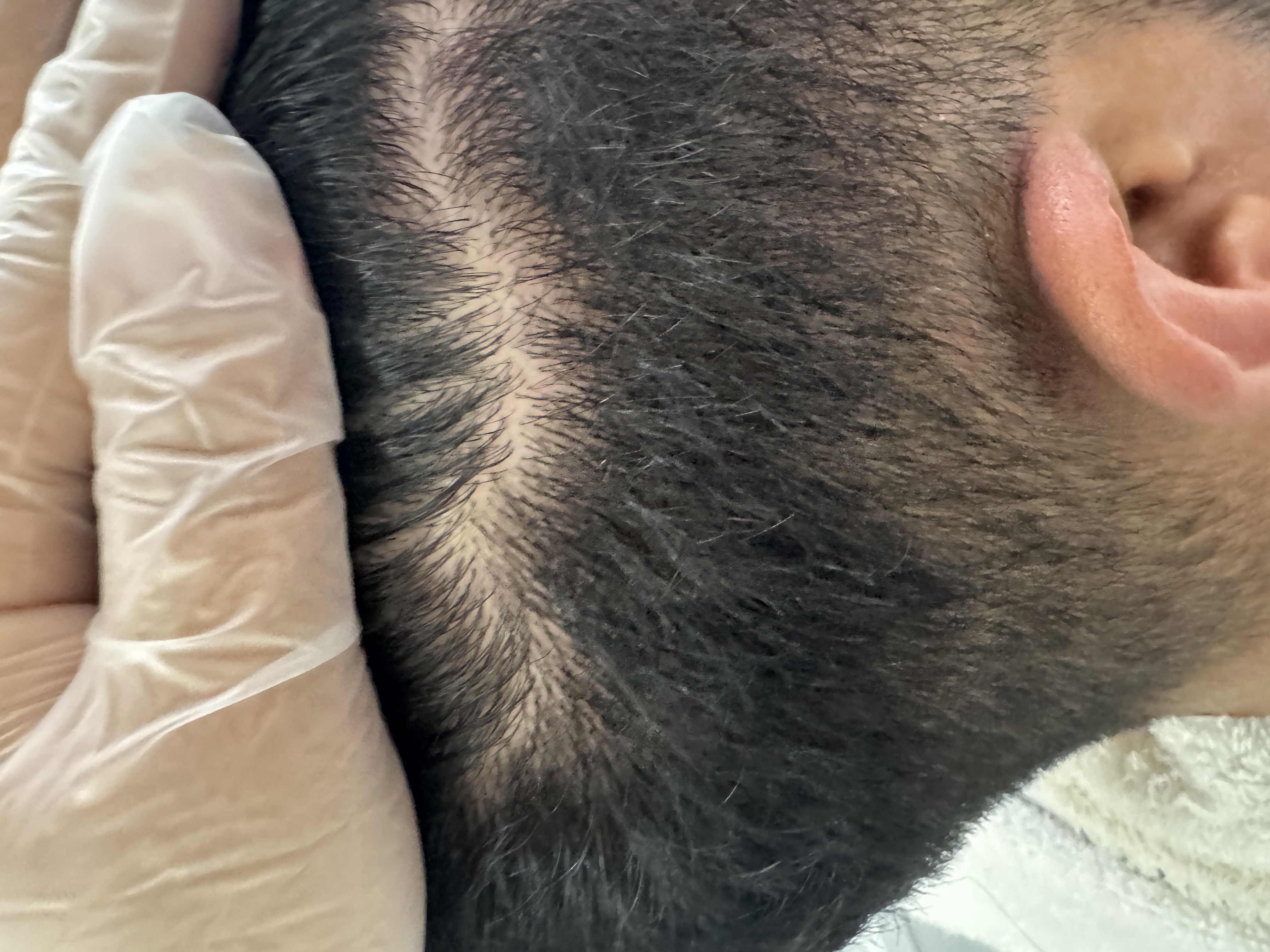 Dermatitis después
