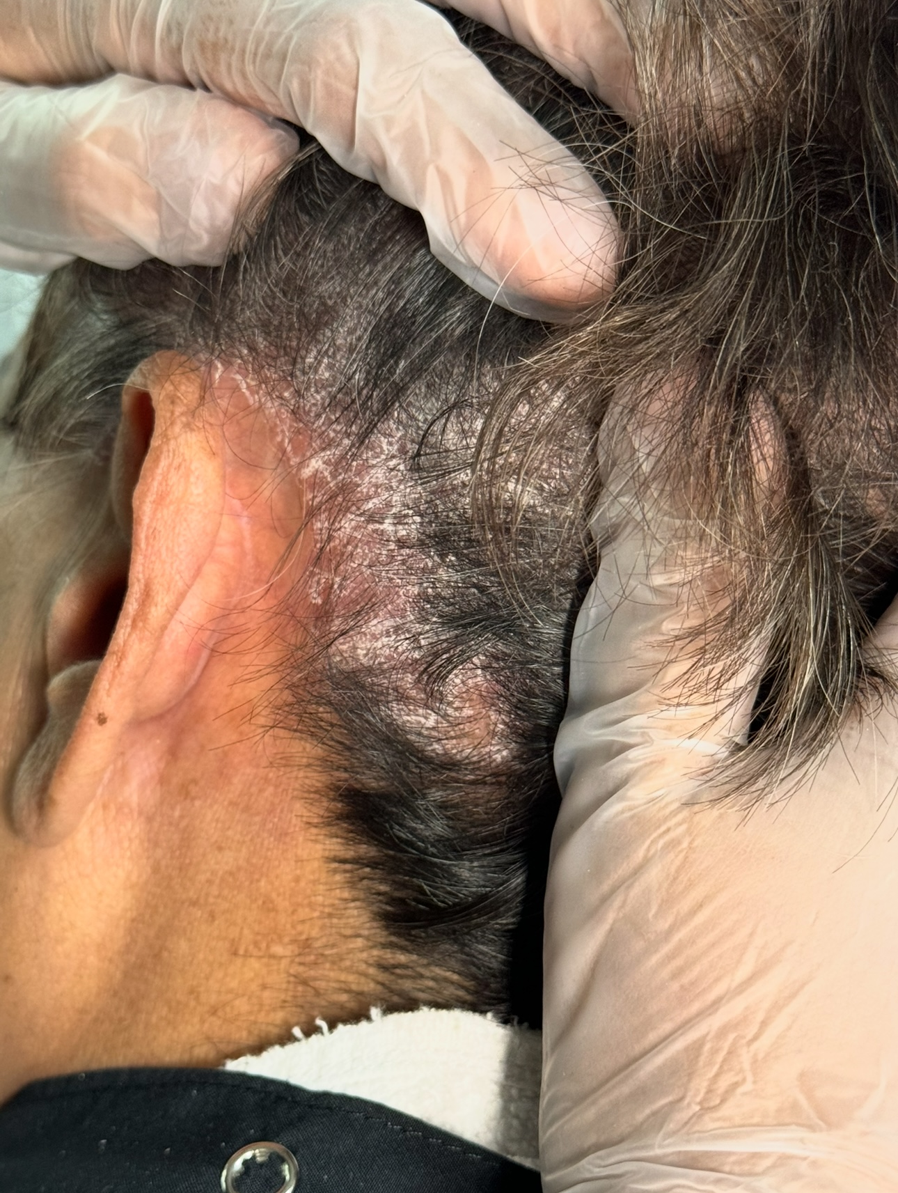 Psoriasis Capilar antes