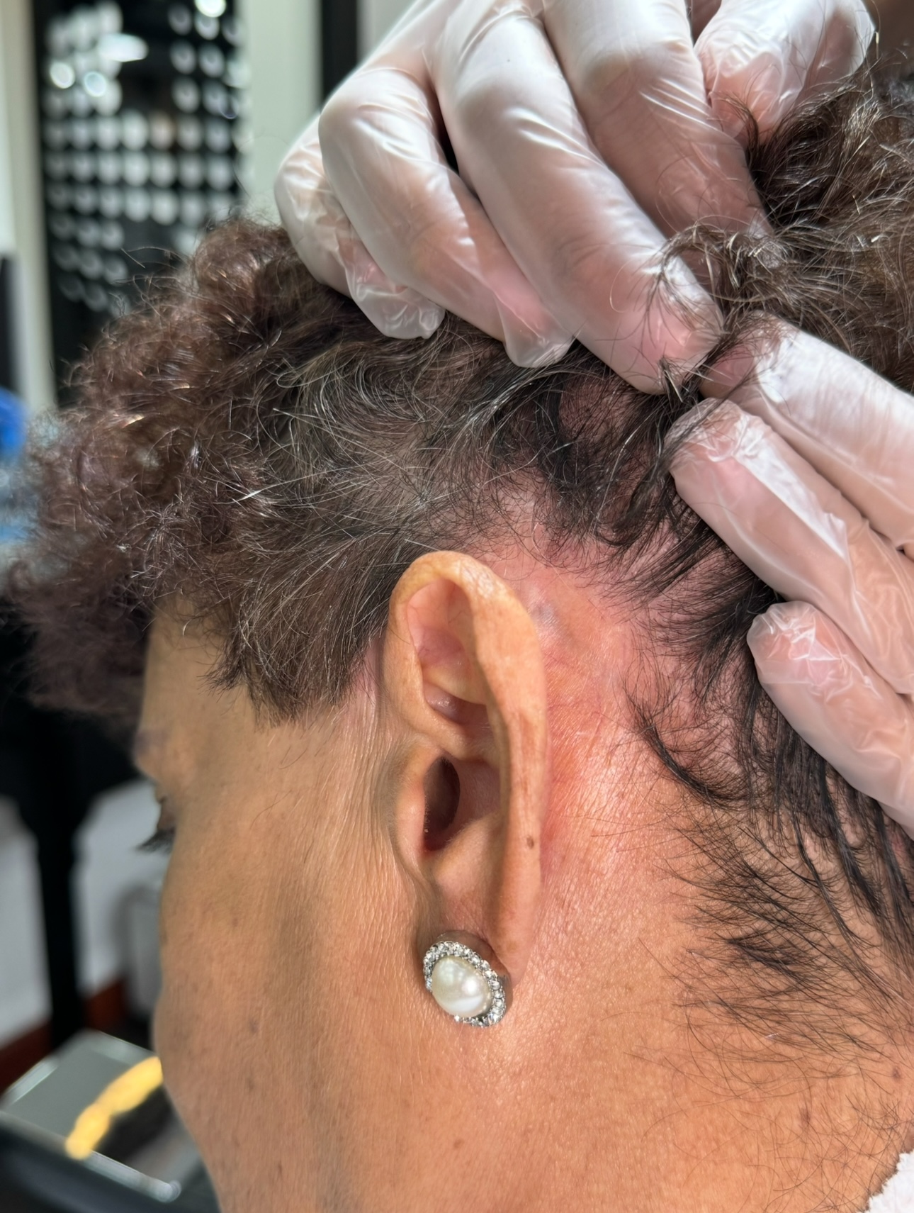 Psoriasis Capilar después