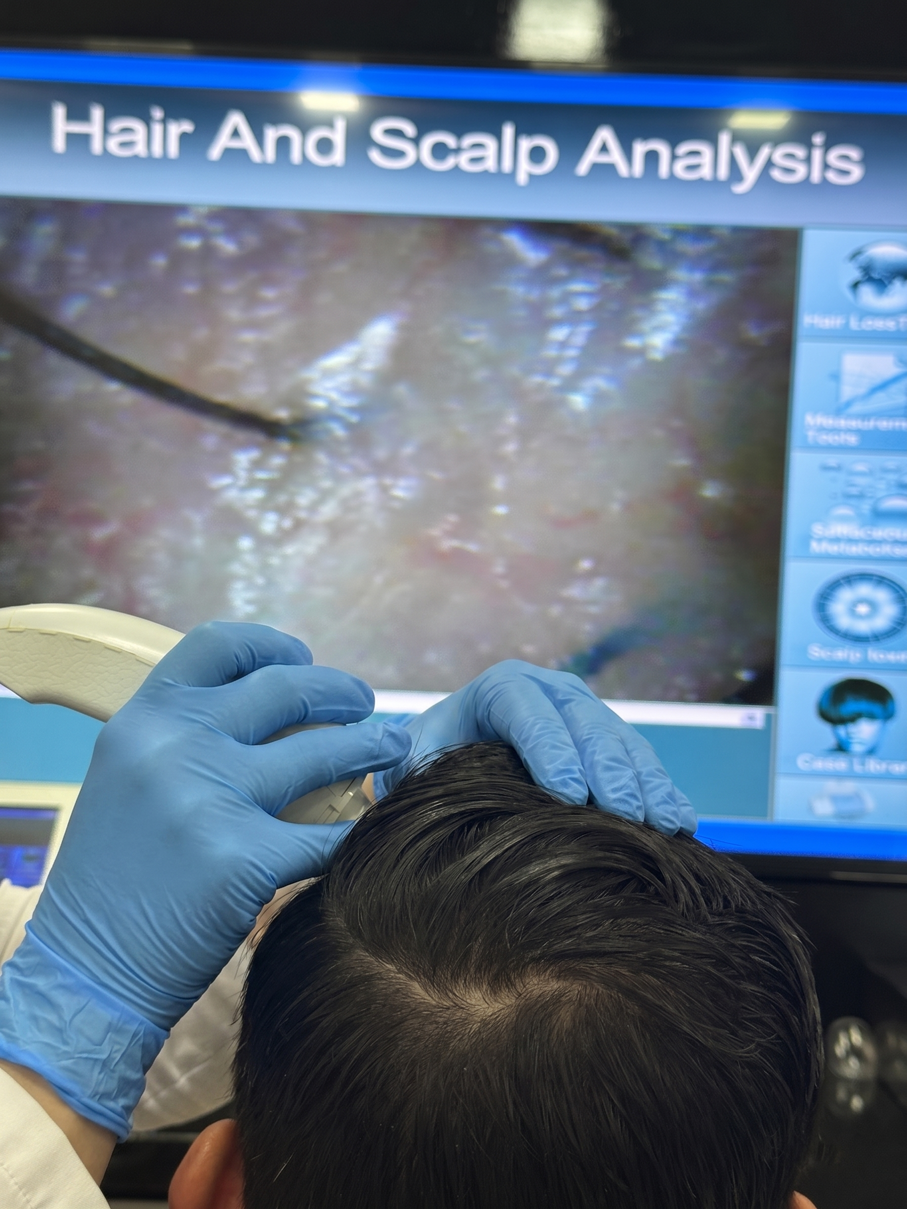 Profilaxis Capilar